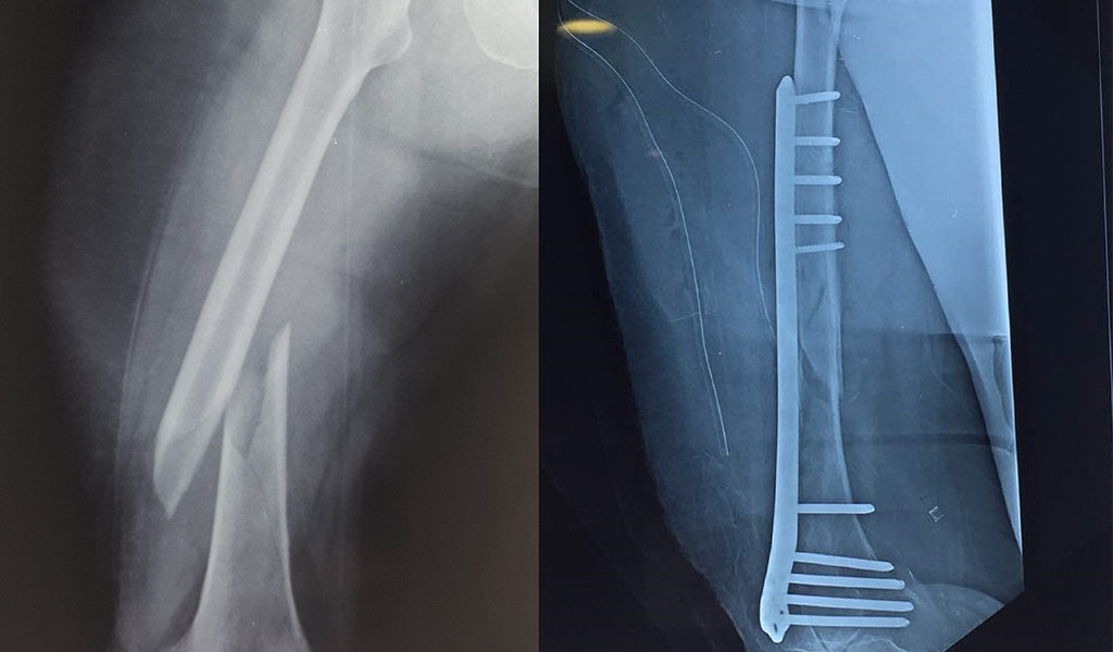 Fracture of the Femur (Thigh Bone) Pre Operative and Post Operative Xrays