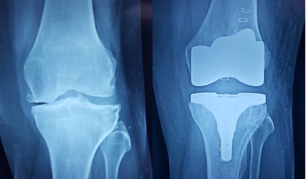 Total Knee Replacement : Pre Op and Post Op X-Rays