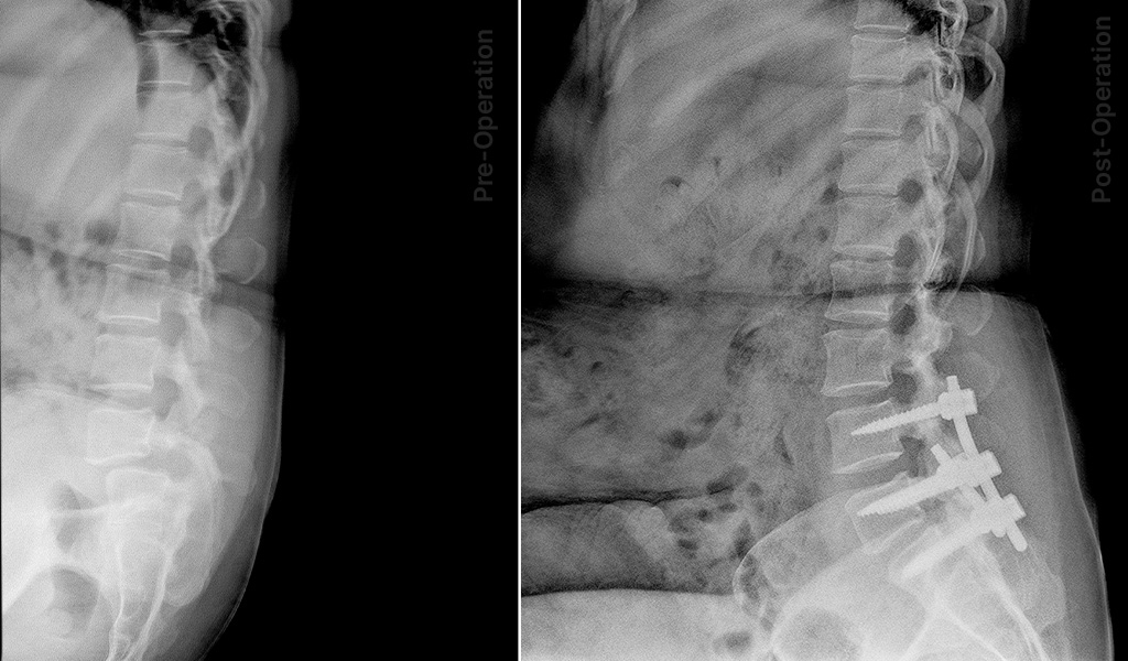 Spine Xray : Instability Correction Pre-Operative and Post Op X-Rays